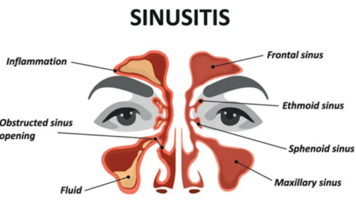 Làm thế nào bệnh viêm xoang Sinusitis ảnh hưởng đến giấc ngủ của bạn